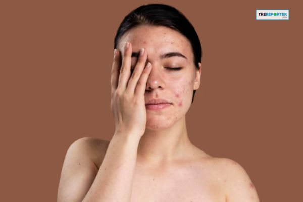 5 แนวทางการรับมือกับ ฝ้าหลังคลอด